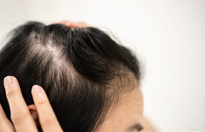 Androgenetic Alopecia