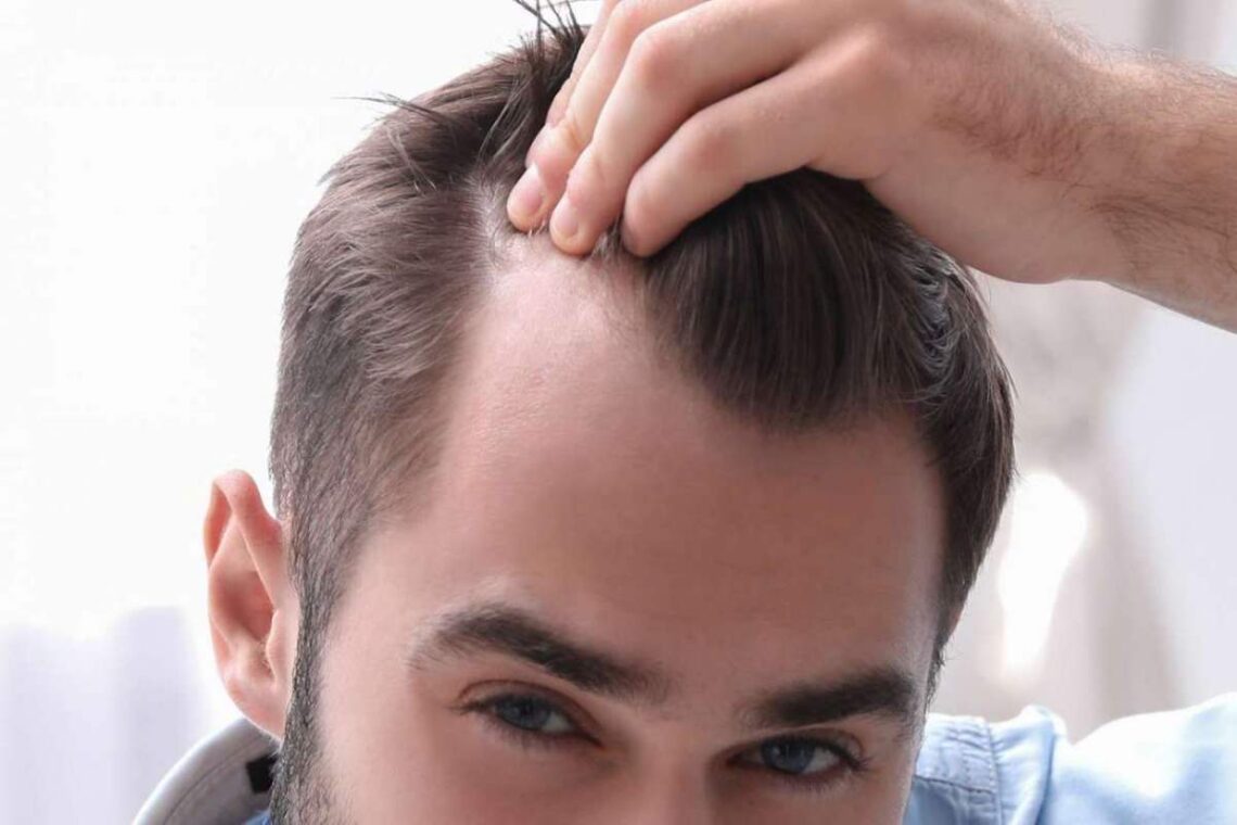 How To Tell If Your Hairline is Receding