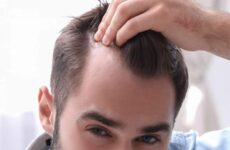 How To Tell If Your Hairline is Receding